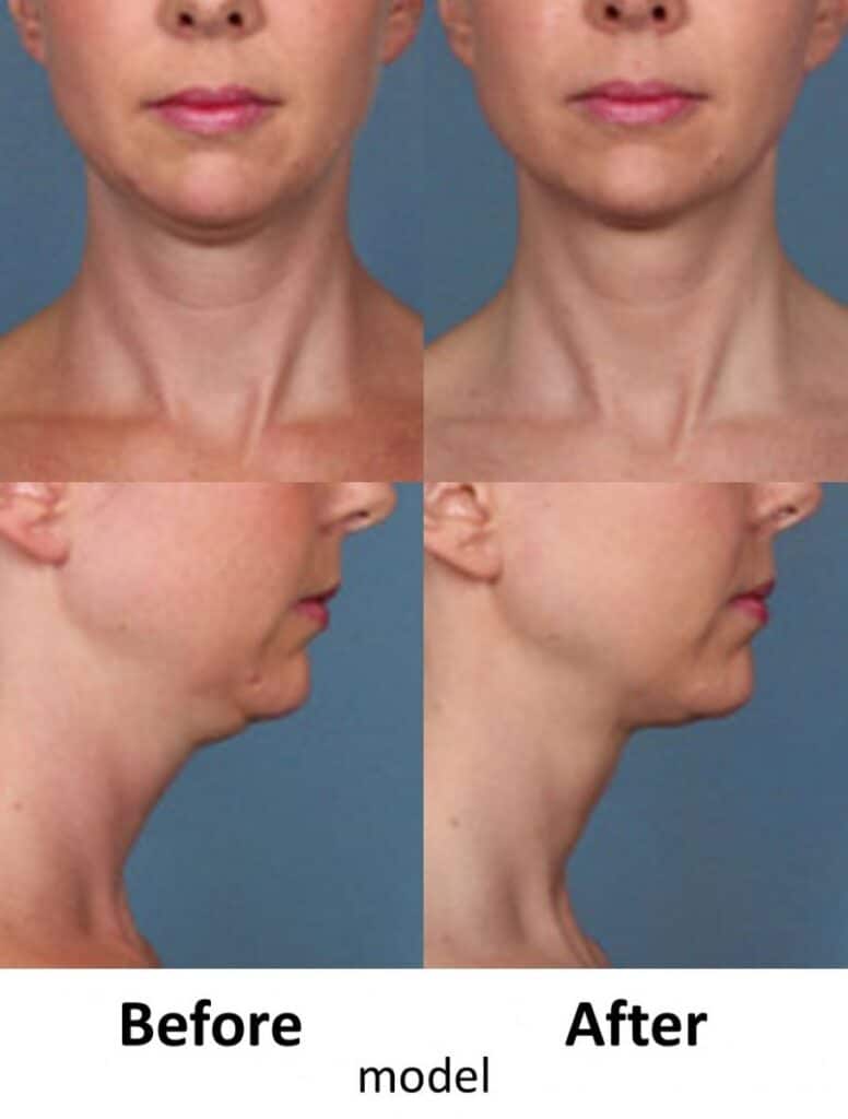 Kybella-before-and-after-01 Juarez
