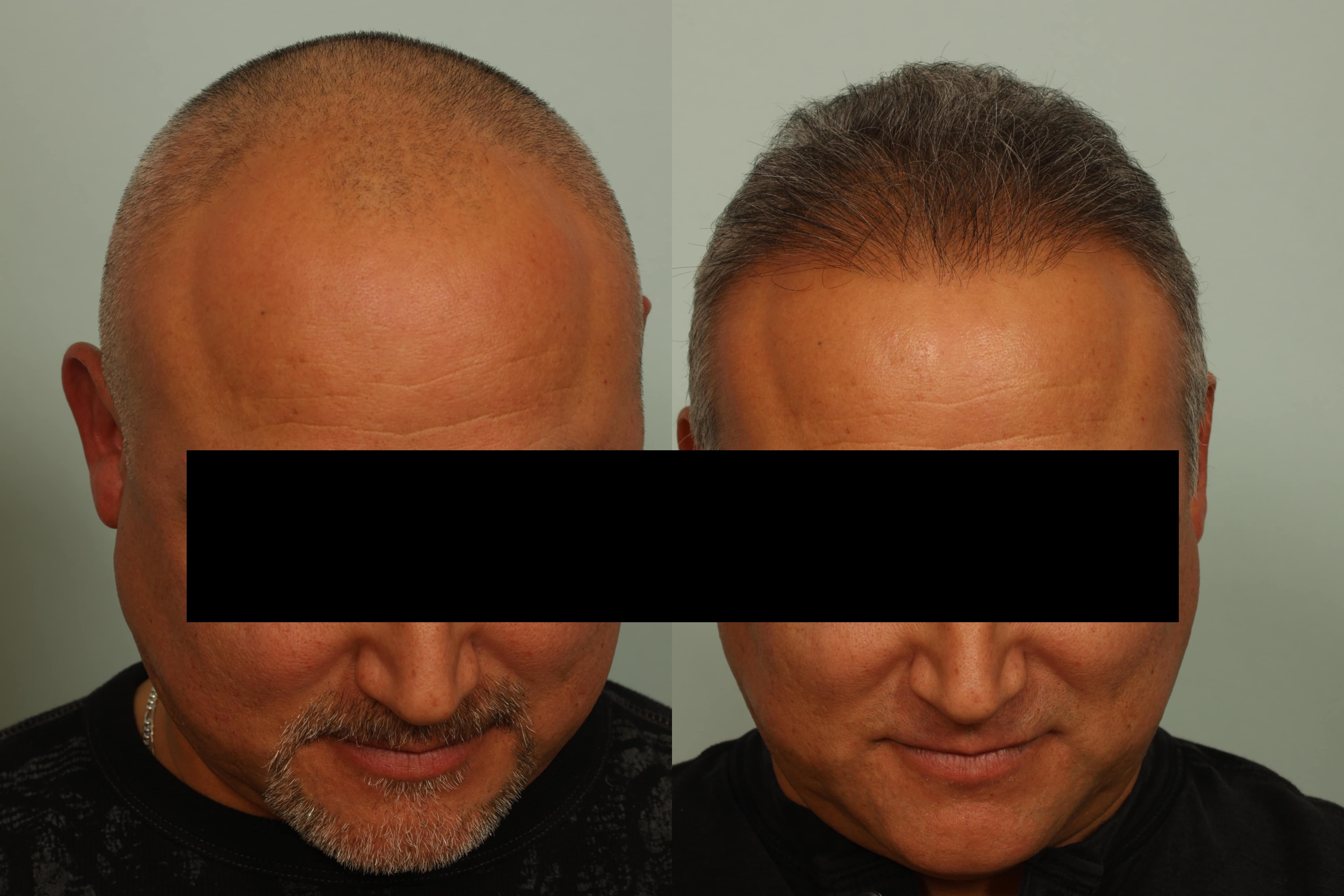 Hair Restoration El Paso Cosmetic Surgery