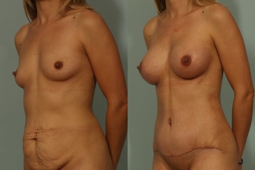 Breast Augmentation Cosmetic Surgery El Paso
