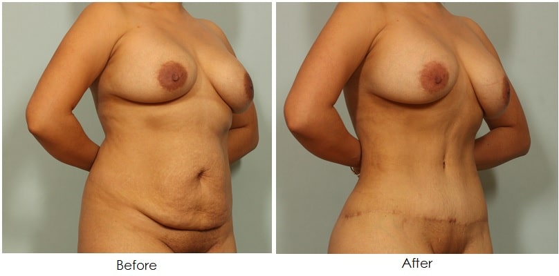Tummy Tuck Before and After El Paso