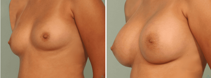 Breast Augmentation Procedure El Paso