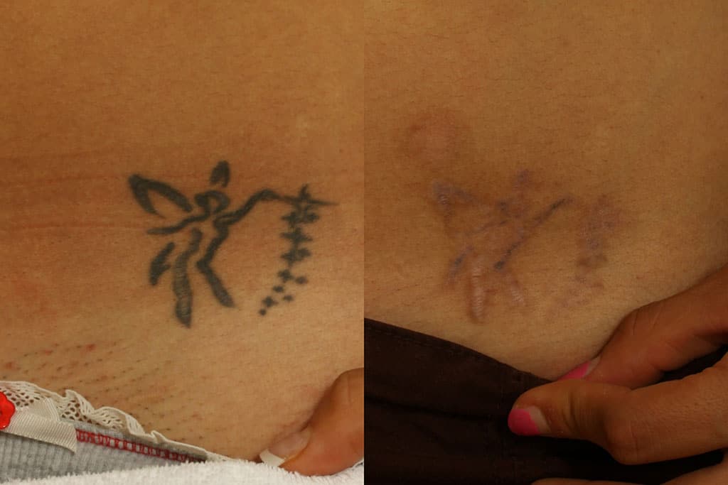 Tattoo Remove, El Paso Cosmetic Surgery | El Paso