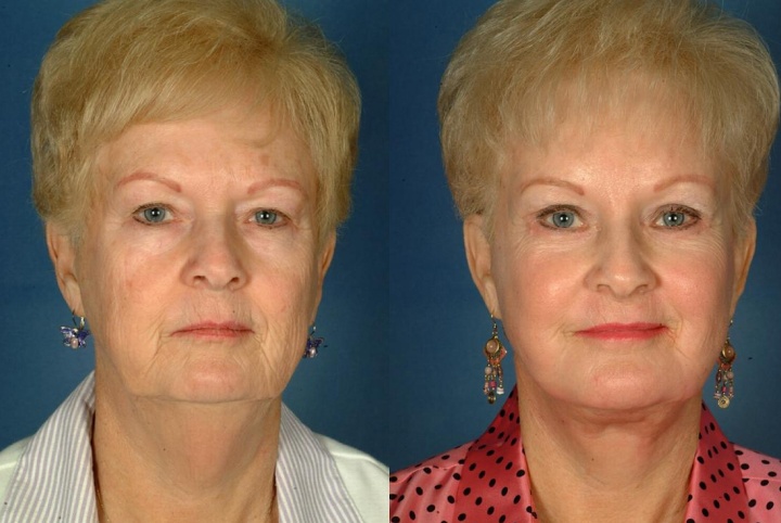 - El Paso Cosmetic Surgery Brow Lift Before & After, El Paso Cosmetic Surgery | El Paso