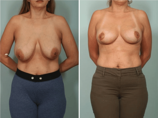 Breast Reduction El Paso