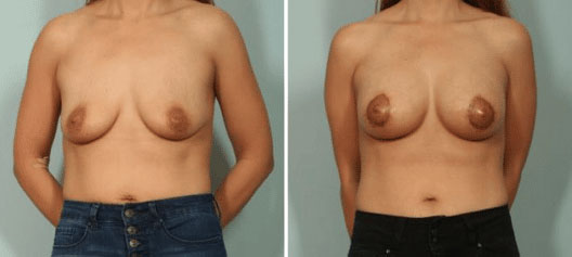 Breast Reconstruction El Paso