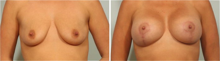 El Paso Breast Procedures - Breast Lift