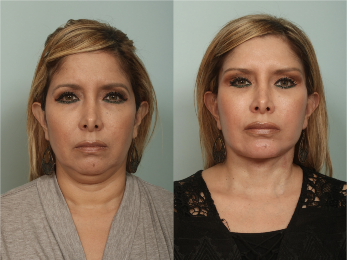 Facelift El Paso Rhytidectomy El Paso Cosmetic Surgery