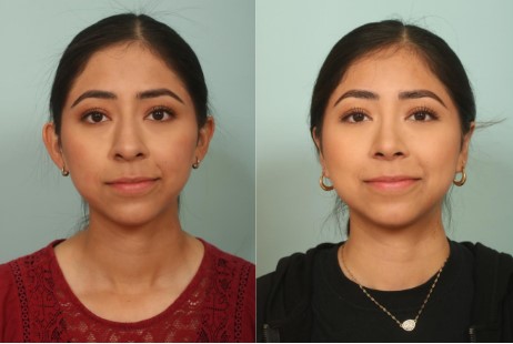 Before-after-ear-surgery - El Paso Cosmetic Surgery Ear Surgery El Paso