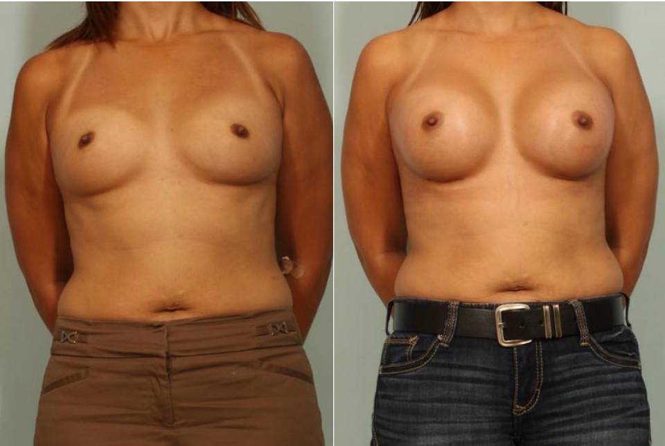 Breast Augmentation El Paso & Juarez - El Paso Cosmetic Surgery Breast Augmentation El Paso & Juarez