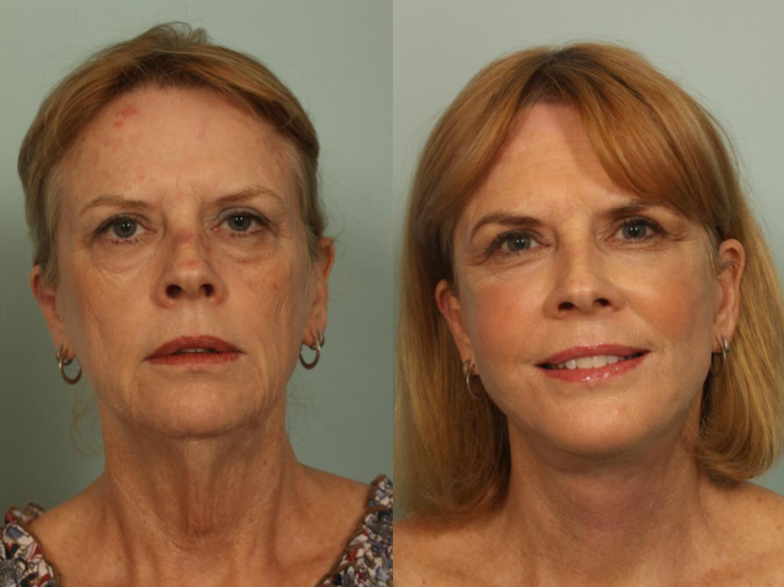 Scarless Facelift El Paso & Juarez - El Paso Cosmetic Surgery Scarless Facelift El Paso & Juarez