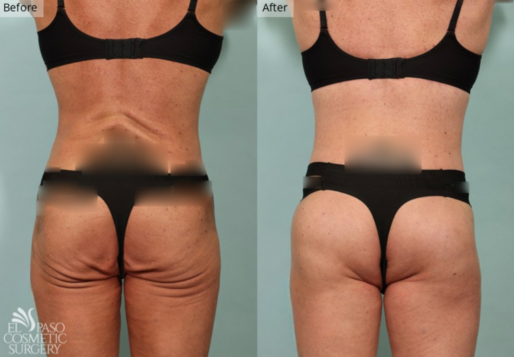 Brazilian Butt Lift, El Paso & Juarez - El Paso Cosmetic Surgery Brazilian Butt Lift, El Paso & Juarez