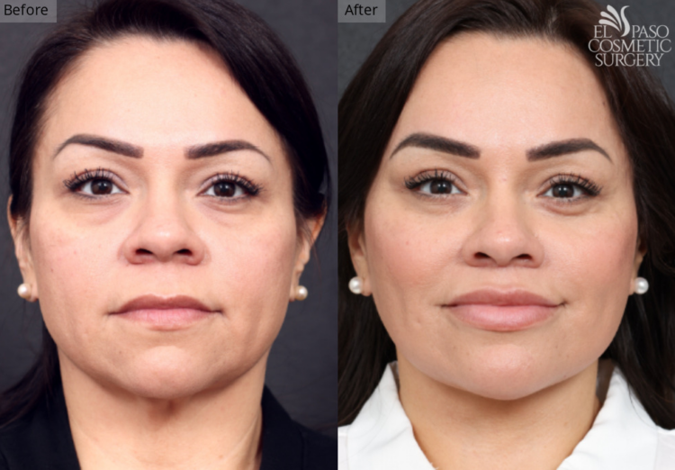 Facelift, El Paso & Juarez - El Paso Cosmetic Surgery Facelift, El Paso & Juarez