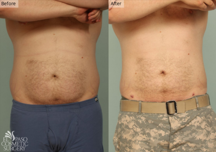 Liposuction, El Paso & Juarez - El Paso Cosmetic Surgery Liposuction, El Paso & Juarez