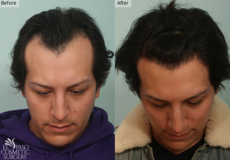Hair Restoration, El Paso & Juarez - El Paso Cosmetic Surgery Hair Restoration, El Paso & Juarez