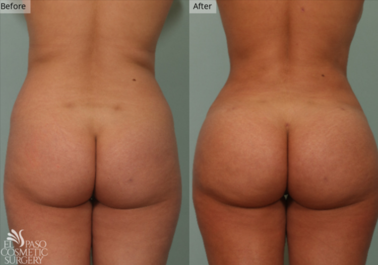 Brazilian Butt Lift, El Paso & Juarez