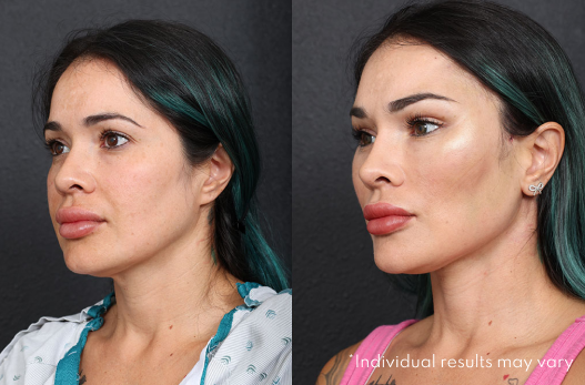 Glidelift Before After - El Paso Cosmetic Surgery